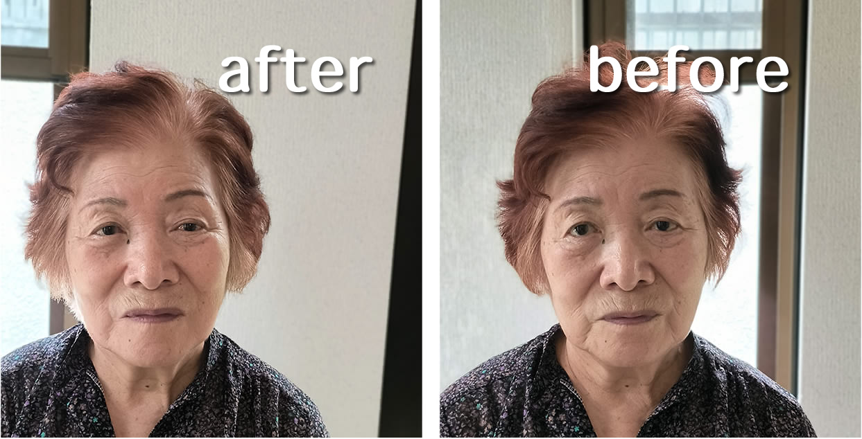 美容鍼ビフォーアフター